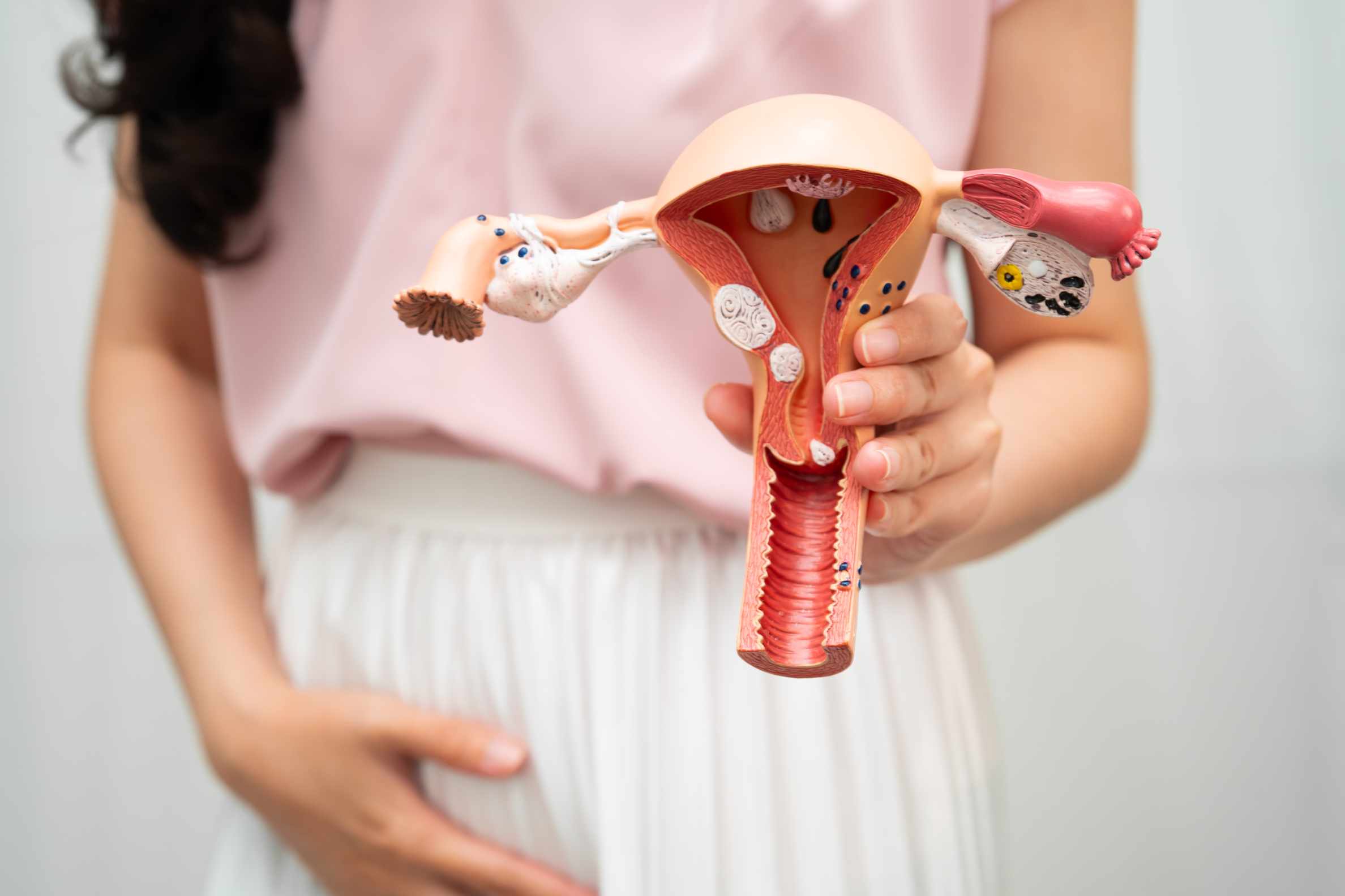 Tratamiento integral para Miomatosis Uterina con el Dr. Guillermo Rosas Alvarado - Enfoque personalizado