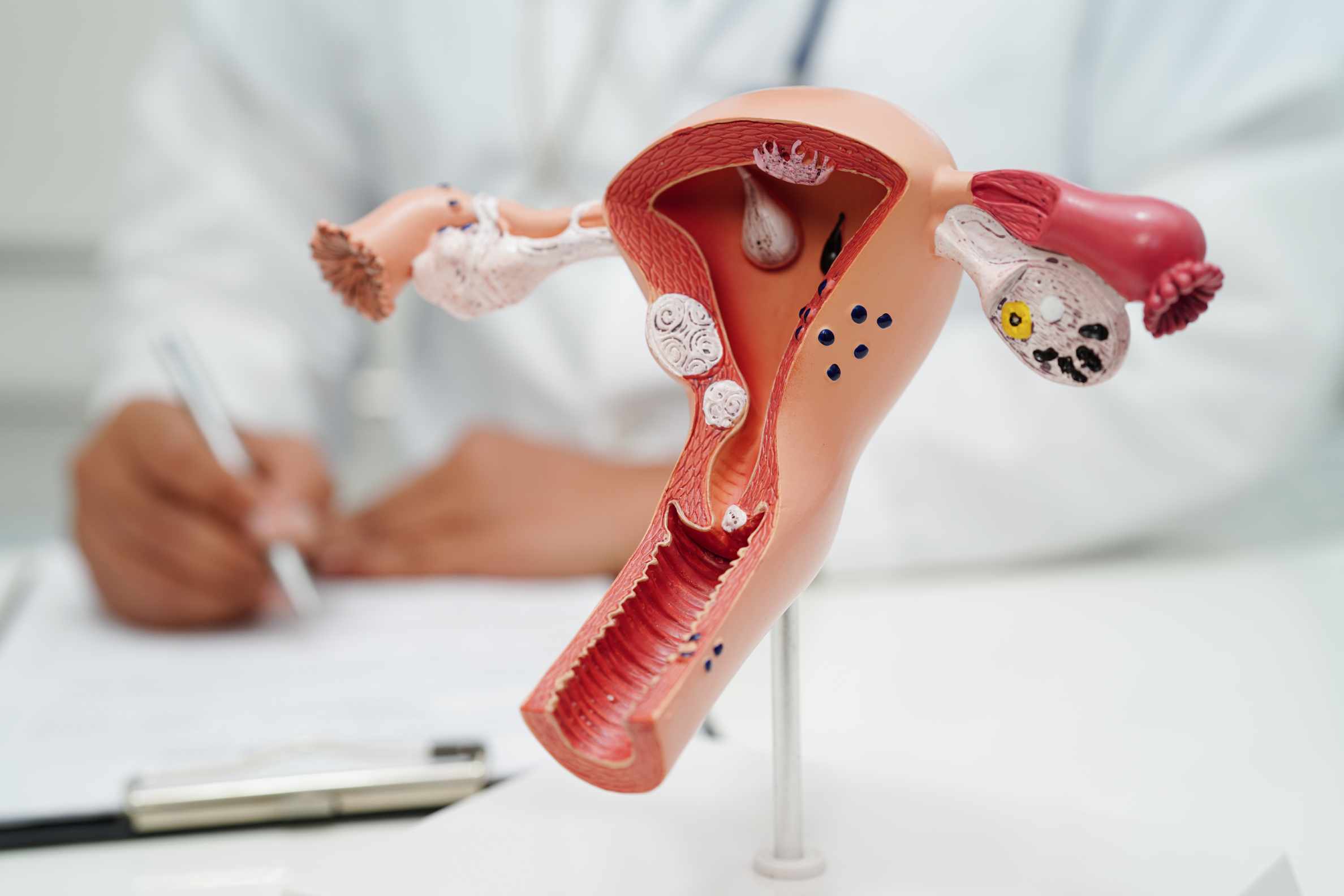 Tumores y quistes de ovarios